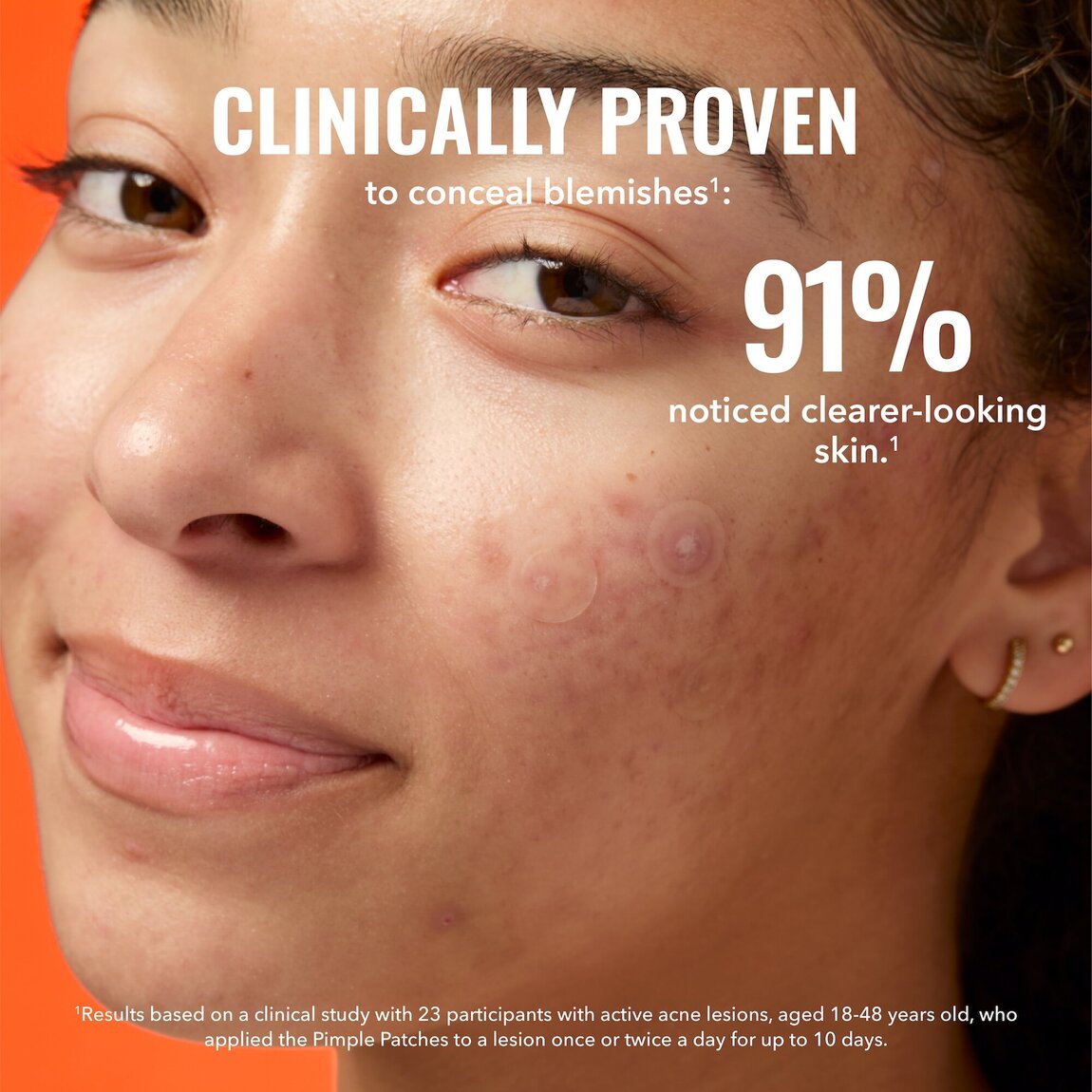 pimple-patches-k1 zb_p.jpg